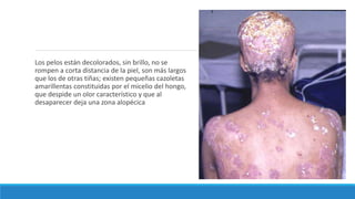 Los pelos están decolorados, sin brillo, no se
rompen a corta distancia de la piel, son más largos
que los de otras tiñas; existen pequeñas cazoletas
amarillentas constituidas por el micelio del hongo,
que despide un olor característico y que al
desaparecer deja una zona alopécica
 