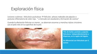 Exploración física
Lesiones cutáneas : foliculosis pustulosas  folículos pilosos rodeados de pápulas o
pústulas inflamatoria de color rojo. “ a menudo con exudación y formación de costras”
Cuando la afectación folicular es menor , se observan escamas y manchas rojizas circulares
con el pelo roto en la superficie de la piel.
Tiña de barba: pustulas y papulas
foliculares independientemente y
dispersas, en la región del bigote.
Dx diferencial con foliculosis por S.
aureus
 