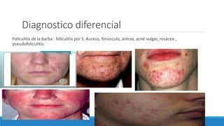 Diagnostico diferencial
Foliculitis de la barba : foliculitis por S. Aureus, forúnculo, ántrax, acné vulgar, rosácea ,
pseudofoliculitis.
 