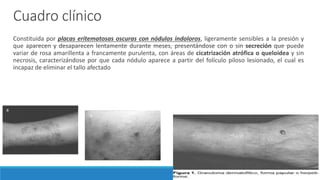 Cuadro clínico
Constituida por placas eritematosas oscuras con nódulos indoloros, ligeramente sensibles a la presión y
que aparecen y desaparecen lentamente durante meses, presentándose con o sin secreción que puede
variar de rosa amarillenta a francamente purulenta, con áreas de cicatrización atrófica o queloidea y sin
necrosis, caracterizándose por que cada nódulo aparece a partir del folículo piloso lesionado, el cual es
incapaz de eliminar el tallo afectado
 