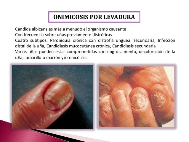 Atopichesky la dermatitis el cambio del clima