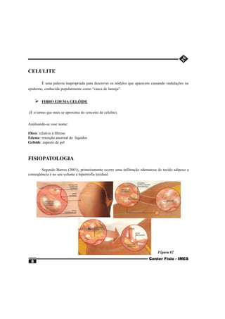 CELULITE

        É uma palavra inapropriada para descrever os nódulos que aparecem causando ondulações na
epiderme, conhecida popularmente como “casca de laranja”.


     Ø   FIBRO EDEMA GELÓIDE

(É o termo que mais se aproxima do conceito de celulite).


Analisando-se esse nome:

Fibro: relativo à fibrose
Edema: retenção anormal de líquidos
Gelóide: aspecto de gel



FISIOPATOLOGIA

        Segundo Barros (2001), primeiramente ocorre uma infiltração edematosa do tecido adiposo a
conseqüência é no seu volume a hipertrofia tecidual.




                                                                              Figura 02
                                                                         Center Fisio - IMES
 8
 