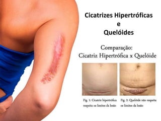 Cicatrizes Hipertróficas
e
Quelóides
 