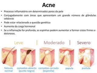 • Processo inflamatório em determinados poros da pele
• Conjugadamente com áreas que apresentam um grande número de glândulas
sebáceas
• Pode estar relacionado a questão genética
• Aumento da carga hormonal
• Se a inflamação for profunda, as espinhas podem aumentar a formar cistos firmes e
dolorosos.
Acne
 