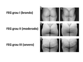 FEG grau I (brando)
FEG grau II (moderado)
FEG grau III (severo)
 