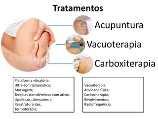 Tratamentos
Acupuntura
Vacuoterapia
Carboxiterapia
Plataforma vibratória;
Ultra-som terapêutico;
Massagem;
Terapias transdérmicas com ativos
Lipolíticos, drenantes e
Reestruturantes;
Termoterapia;
Vacuoterapia;
Atividade física;
Carboxiterapia;
Envolvimentos;
Radiofrequência.
 