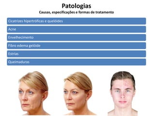 Patologias
Causas, especificações e formas de tratamento
Cicatrizes hipertróficas e quelóides
Acne
Envelhecimento
Fibro edema gelóide
Estrias
Queimaduras
 