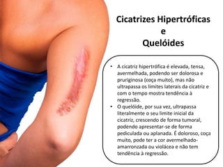 Cicatrizes Hipertróficas
e
Quelóides
• A cicatriz hipertrófica é elevada, tensa,
avermelhada, podendo ser dolorosa e
pruriginosa (coça muito), mas não
ultrapassa os limites laterais da cicatriz e
com o tempo mostra tendência à
regressão.
• O quelóide, por sua vez, ultrapassa
literalmente o seu limite inicial da
cicatriz, crescendo de forma tumoral,
podendo apresentar-se de forma
pediculada ou aplanada. É doloroso, coça
muito, pode ter a cor avermelhado-
amarronzada ou violácea e não tem
tendência à regressão.
 