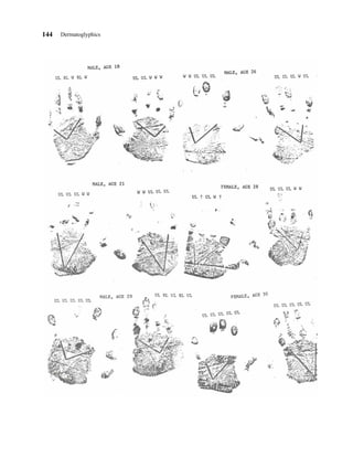 144   Dermatoglyphics
 