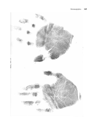 Dermatoglyphics   145
 