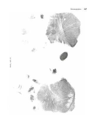 Dermatoglyphics   147
 