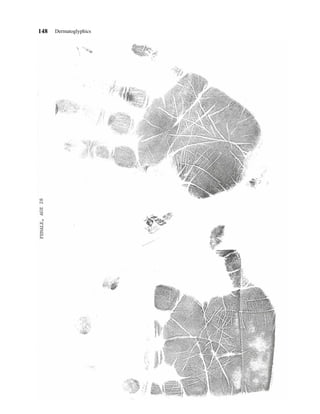 148   Dermatoglyphics
 