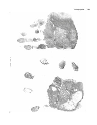 Dermatoglyphics   149
 