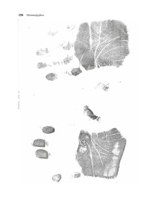 150   Dermatoglyphics
 