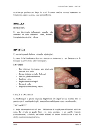 Universidad Católica Boliviana “San Pablo”



secuelas que puedan tener luego del acné. Por estos motivos es muy importante un
tratamiento precoz, oportuno y de la mejor forma.



ROSACEA
DEFINICION:

Es una dermopatía inflamatoria vascular más
frecuente en sexo femenino. Rubor, Eritema,
telangiectasias, pústula y edema.




RINOFIMA
Es una nariz grande, bulbosa y de color rojo (rojizo).

La causa de la Rinofima se desconoce aunque se piensa que es una forma severa de
Rosácea. Es un trastorno relativamente raro.

SINTOMAS

   -   Los síntomas involucran una apariencia
       anormal de la nariz
   -   Forma similar a un bulbo (bulbosa)
   -   Muchas glándulas sebáceas
   -   Puede ser rojizo
   -   Engrosamiento de la piel
   -   Forma de bulbo
   -   Superficie amarillenta y serosa



SIGNOS Y EXAMENES

La rinofima por lo general se puede diagnosticar sin ningún tipo de examen, pero se
puede requerir una biopsia de piel para confirmar el diagnostico en casos inusuales.

TRATAMIENTO

El mejor tratamiento conocido para l rinofima es la cirugía para moldear de nuevo la
nariz. La cirugía se puede hacer con laser, escalpelo o un cepillo rotatorio
(dermoabrasión). Asimismo ha habido informes de buenos resultados con el uso de
ciertos medicamentos para el acné.


ACNÉ                                                                                    Página 6
 
