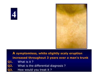 4



   A symptomless, white slightly scaly eruption
   increased throughout 3 years over a man's trunk
Q1.    What is it ?
Q2.    What is the differential diagnosis ?
Q3.    How would you treat it ?
 