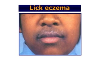 Lick eczema
 
