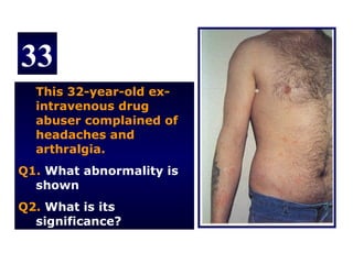 33
  This 32-year-old ex-
  intravenous drug
  abuser complained of
  headaches and
  arthralgia.
Q1. What abnormality is
  shown
Q2. What is its
  significance?
 
