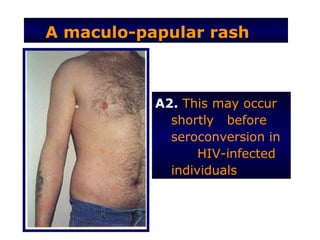 A maculo-papular rash



           A2. This may occur
             shortly before
             seroconversion in
                  HIV-infected
             individuals
 