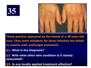 35

These patches appeared on the hands of a 40-year-old
man. They were mistaken for tinea infection but failed
to resolve with antifungal treatment.

Q1. What is the diagnosis?

Q2. With what other skin condition is it closely
associated?

Q3. Is any locally applied treatment effective?
 