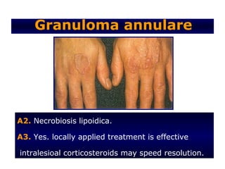 Granuloma annulare




A2. Necrobiosis lipoidica.

A3. Yes. locally applied treatment is effective

intralesioal corticosteroids may speed resolution.
 