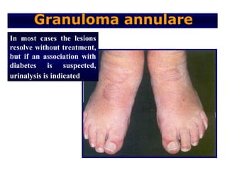 Granuloma annulare
In most cases the lesions
resolve without treatment,
but if an association with
diabetes is suspected,
urinalysis is indicated
 