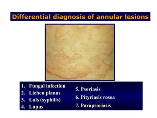 Differential diagnosis of annular lesions




  1.   Fungal infection
                          5. Psoriasis
  2.   Lichen planus
  3.   Luls (syphilis)    6. Pityriasis rosea
  4.   Lupus              7. Parapsoriasis
 
