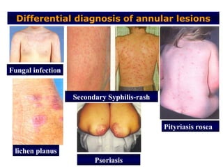 Differential diagnosis of annular lesions




Fungal infection


                   Secondary Syphilis-rash



                                             Pityriasis rosea


 lichen planus
                         Psoriasis
 