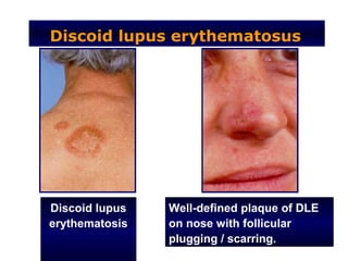Discoid lupus erythematosus




Discoid lupus   Well-defined plaque of DLE
erythematosis   on nose with follicular
                plugging / scarring.
 