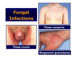 Fungal
Infections
                  Tinea corporis.




 Tinea cruris

                Ringworm granuloma
 