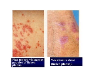 Flat-topped violaceous   Wickham's striae
papules of lichen        (lichen planus).
planus.
 