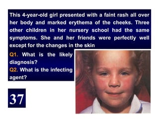 This 4-year-old girl presented with a faint rash all over
her body and marked erythema of the cheeks. Three
other children in her nursery school had the same
symptoms. She and her friends were perfectly well
except for the changes in the skin
Q1. What is the likely
diagnosis?
Q2. What is the infecting
agent?



37
 
