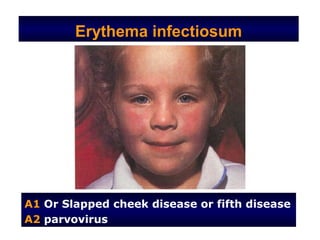 Erythema infectiosum




A1 Or Slapped cheek disease or fifth disease
A2 parvovirus
 