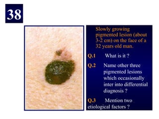 38
        Slowly growing
        pigmented lesion (about
        3-2 cm) on the face of a
        32 years old man.
     Q.1     What is it ?
     Q.2    Name other three
            pigmented lesions
            which occasionally
            inter into differential
            diagnosis ?
     Q.3     Mention two
     etiological factors ?
 