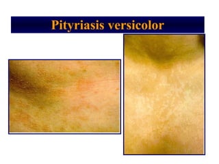 Pityriasis versicolor
 