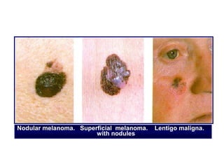 Nodular melanoma. Superficial melanoma.   Lentigo maligna.
                       with nodules
 