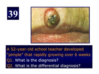 39


A 52-year-old school teacher developed
“pimple” that rapidly growing over 6 weeks
Q1. What is the diagnosis?
Q2. What is the differential diagnosis?
 