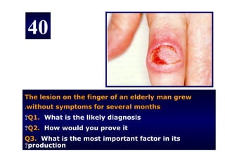40


The lesion on the finger of an elderly man grew
.without symptoms for several months
?Q1. What is the likely diagnosis
?Q2. How would you prove it
Q3. What is the most important factor in its
?production
 