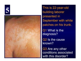 This is 22-year-old
5   building laborer
    presented in
    September with white
    patches on his trunk.
    Q1 What is the
    diagnosis?
    Q2 Is the cause
    known?
    Q3 Are any other
    conditions associated
    with this disorder?
 