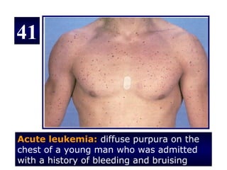 41



Acute leukemia: diffuse purpura on the
chest of a young man who was admitted
with a history of bleeding and bruising
 