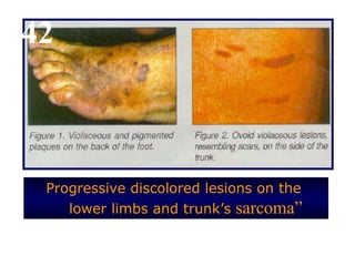 42



 Progressive discolored lesions on the
    lower limbs and trunk’s sarcoma”
 