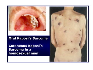 Oral Kaposi’s Sarcoma

Cutaneous Kaposi’s
Sarcoma in a
homosexual man
 