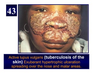 43




Active lupus vulgaris (tuberculosis of the
  skin) Exuberant hypertrophic ulceration
 spreading over the nose and malar areas.
 