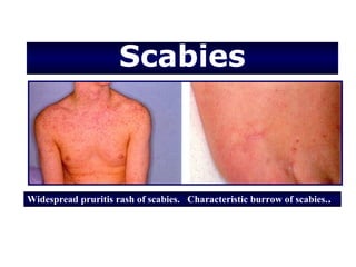 Scabies



Widespread pruritis rash of scabies. Characteristic burrow of scabies. .
 