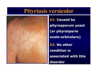 Pityriasis versicolor
          A2. Caused by
          pityrosporum yeast
          (or pityrosporm
          ovale-orbicalare)

          A3. No other
          condition is
          associated with this
          disorder
 