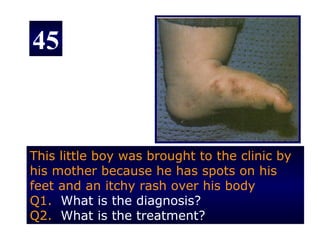 45



This little boy was brought to the clinic by
his mother because he has spots on his
feet and an itchy rash over his body
Q1. What is the diagnosis?
Q2. What is the treatment?
 
