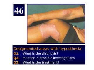 46


Depigmented areas with hyposthesia
Q1.   What is the diagnosis?
Q2.   Mention 3 possible investigations
Q3.   What is the treatment?
 