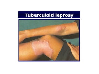 Tuberculoid leprosy
 