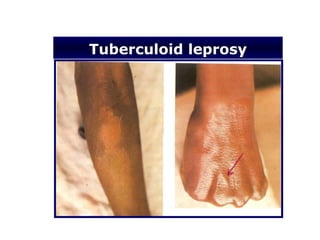 Tuberculoid leprosy
 