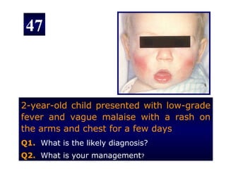 47



2-year-old child presented with low-grade
fever and vague malaise with a rash on
the arms and chest for a few days
Q1. What is the likely diagnosis?
Q2. What is your management?
 